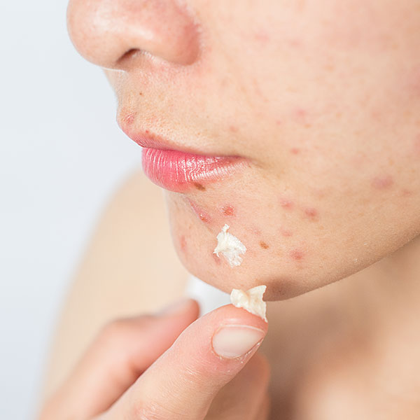 Acne, Imperfezioni e Pelle Grassa